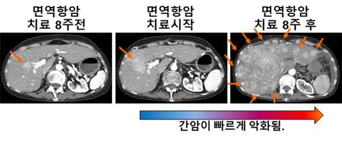 간암의 급성진행을 보여주는 간암 환자의 CT 사진