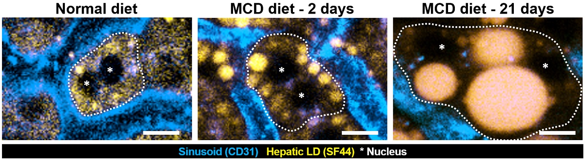 간세포 내 크기가 큰 지방구(Lipid droplet,황색) 형성으로 인한 간세포 핵의 위치변화 및 간세포의 모양 변화(점선)