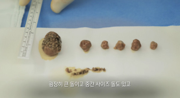 '생로병사의 비밀' 돌 담석증 원인·치료법 공개